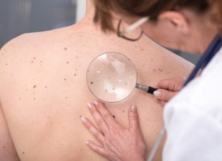 Доктор Мясников рассказал, когда родинки могут стать фактором риска