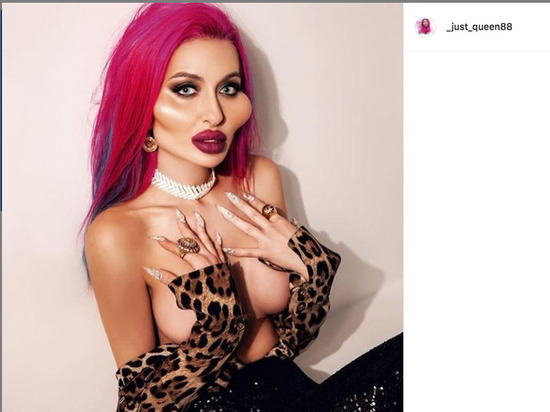 Женщина с самыми большими щеками в мире решила увеличить грудь