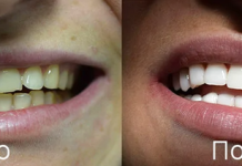 Что такое виниры и для чего они нужны