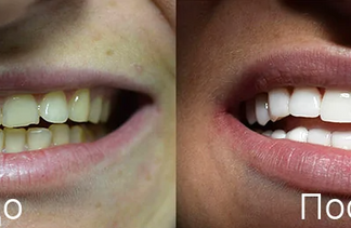 Что такое виниры и для чего они нужны