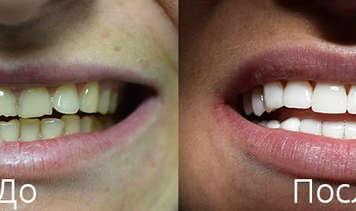 Что такое виниры и для чего они нужны