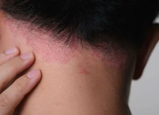 Псориаз волосистой части головы: современные подходы к уходу и лечению