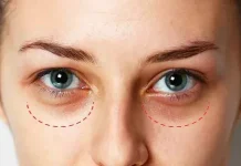 Современный подход к восстановлению свежести взгляда: лазерная шлифовка темных кругов под глазами