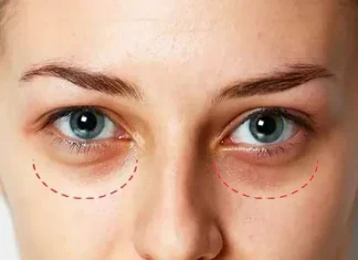 Современный подход к восстановлению свежести взгляда: лазерная шлифовка темных кругов под глазами