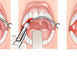 Тонзиллэктомия: современный подход к здоровью горла