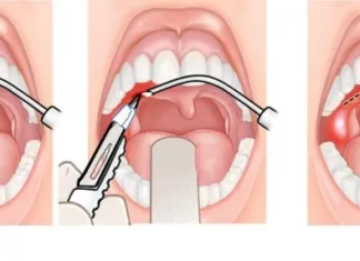 Тонзиллэктомия: современный подход к здоровью горла