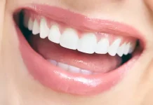 Виниры и их использование: идеальная улыбка доступна каждому