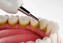 Почему нужно делать профессиональную чистку зубов: здоровье и красота вашей улыбки