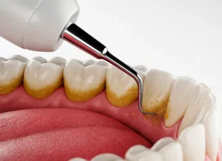 Почему нужно делать профессиональную чистку зубов: здоровье и красота вашей улыбки