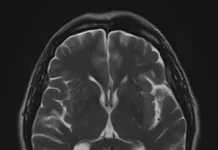 Как проводится МРТ головного мозга: подробное руководство