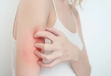 Как лечить псориаз: современные подходы и эффективные методы