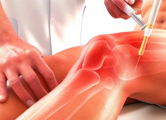 Использование плазмолифтинга при лечении колен: эффективный метод восстановления суставов
