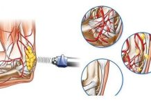 Механизм воздействия ударно волновой терапии