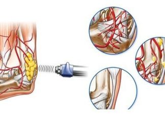 Механизм воздействия ударно волновой терапии